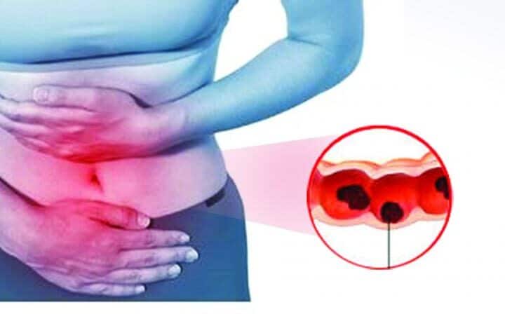 Abdominal Tuberculosis TB